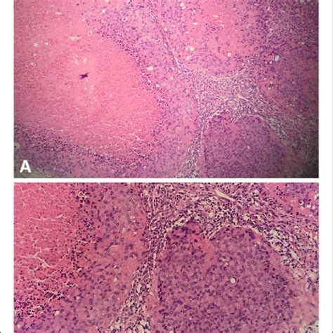 Microscopic Findings Of The Right Axillary Lymph Nodes Hande Staining