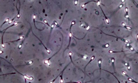 Study Turns Skin Tissue From Infertile Men Into Early Stage Sperm Cells