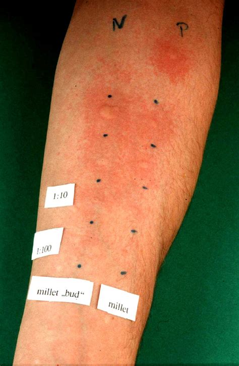 Positive Reaction In The Skin Prick Test To A Diluted And Undiluted