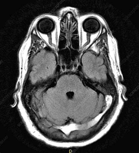 Extensive Dural Sinus Thrombosis Mri Stock Image C0365122