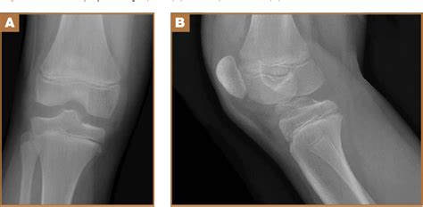 Figure 2 From Arthroscopic Treatment Of Tibial Spine Malunion With
