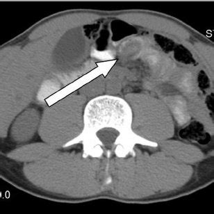 CT Abdomen Pelvis Without Contrast Note The Intussusception In The