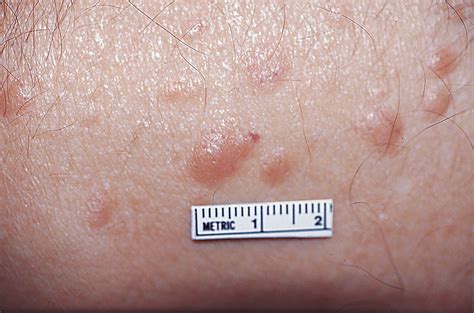 Multiple Subcutaneous Nodules On The Torso And Leg Dermatology Jama