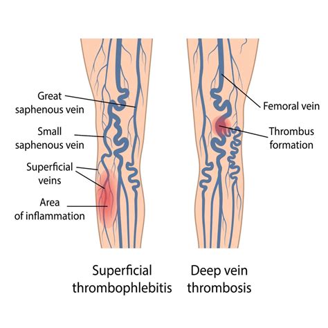 Can Your Varicose Veins Lead To Serious Vein Diseases St Louis Laser Veins