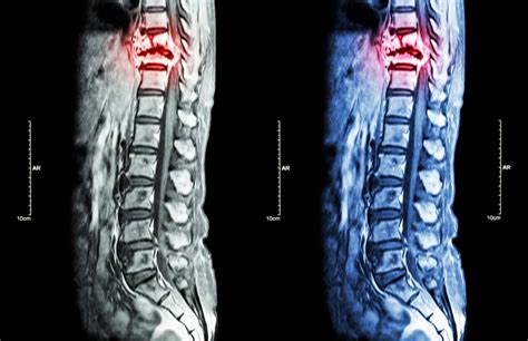 The Different Spinal Fracture Types Explained Decobizz Lifestyle Blog