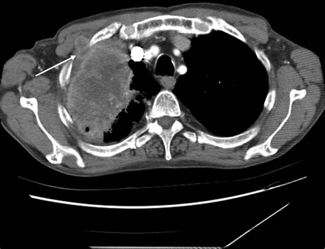 Contrast Enhanced Computed Tomography Ct Scan 2 Months After The