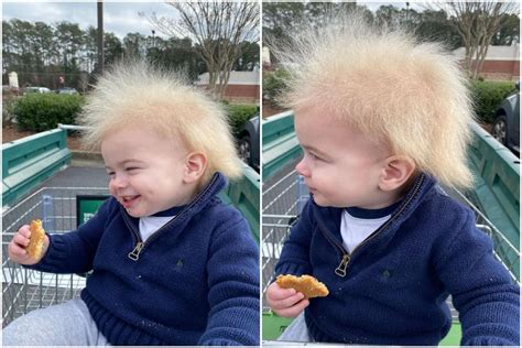 After Baby Goes Viral Expert Explains Uncombable Hair Syndrome Lupon