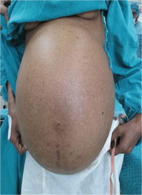 Hugely Distended Abdomen In Pseudomyxoma Peritonei Pmp—patient 1