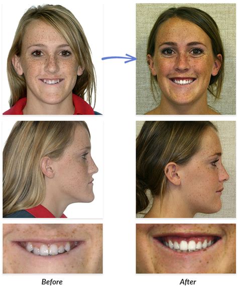 Before And After Braces Photos Delurgio Orthodontics Delurgio Orthodontics