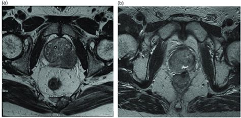 T2 Weighted Mri Sequences Demonstrating A The Tumor On The Left Side
