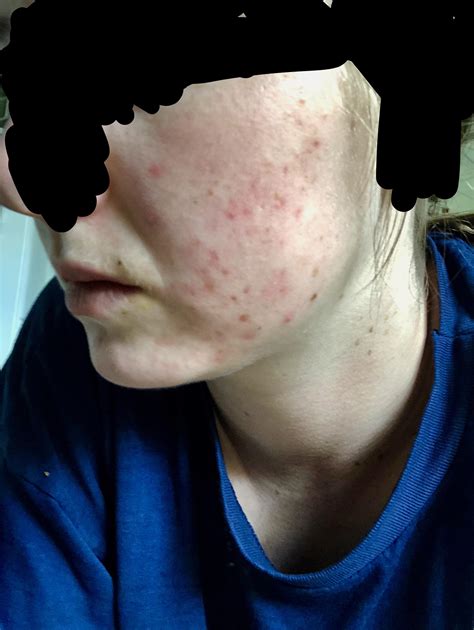 Skin Concern Red Textured Skin Please Help Routine In Comments