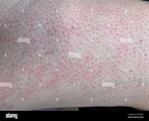 Erythema Hi Res Stock Photography And Images Alamy