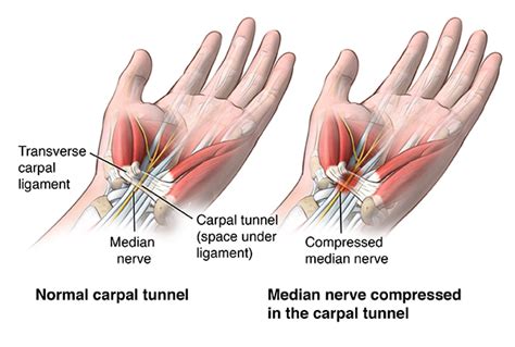 Carpal Tunnel Syndrome Johns Hopkins Medicine