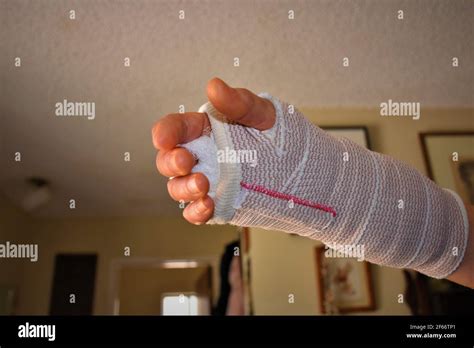 Woman With A Stiff Cast On Her Broken Wrist Which Was Repaired By