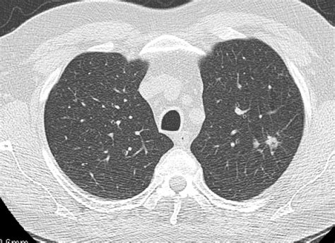 A Classification Of Pulmonary Nodules By Ct Scan Ecancer