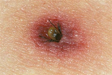 Tick Bites On Humans Images Symptoms Causes Treatment Hubpages My Xxx