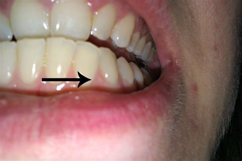 I Have A Small Painless White Bump On Gums