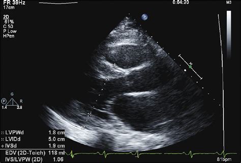 Echocardiography In Systemic Disease Thoracic Key