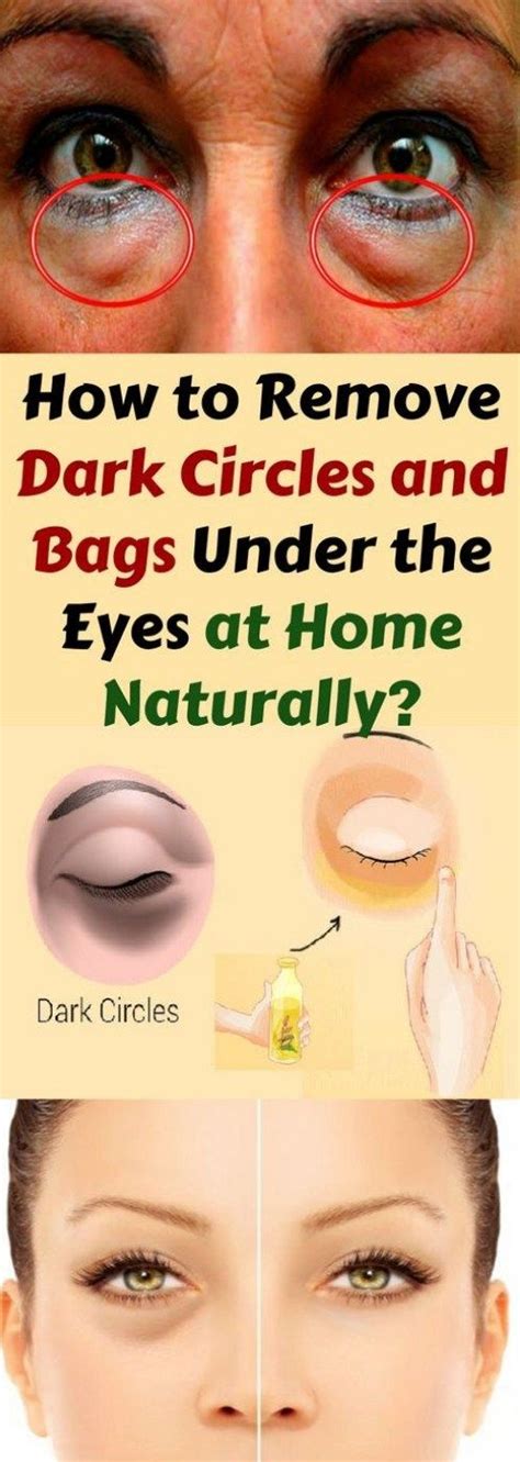 How To Remove Dark Circles And Bags Under The Eyes At Home Naturally
