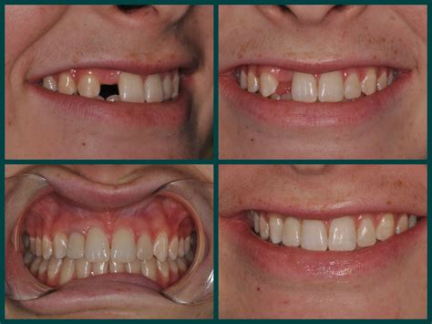 Smile Spotlight Erin Restore Missing Tooth With Dental Implant And Crown