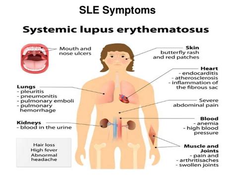 Sle Causes Symptoms Diagnosis Treatment Rxharun