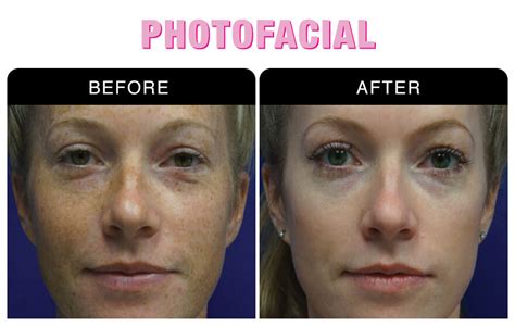 Photofacials For Anti Aging National Laser Institute Medical Spa