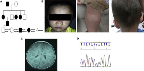 Clinical Characteristics Of The Patient With Tuberous Sclerosis Complex