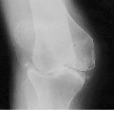 An Anteroposterior Radiograph Shows A Knee With Ra And Severe Tibial