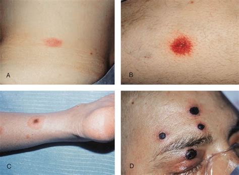 Skin Lesions Associated With Fusarium Infection Journal Of The