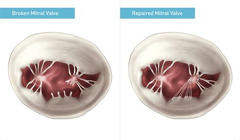 Paradigm Shift In Mitral Valve Repair Mass General Advances In Motion