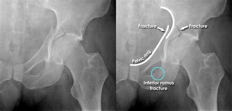 Trauma X Ray Axial Skeleton Gallery 2 Pelvis Acetabular Fractures