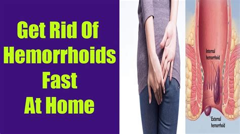 How To Get Rid Of Hemorrhoids Naturally Fast And Easy At Home Youtube