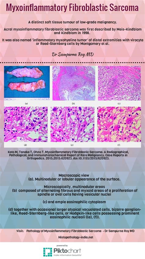 Pathology Of Myxoinflammatory Fibroblastic Sarcoma Sarcoma Pathology
