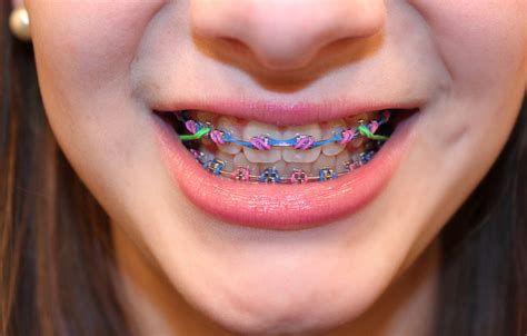 Is It Really That Bad To Eat With Rubber Bands On Your Braces Landm