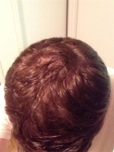 Here are top reasons why people lose hair 1. http://i.imgur.com/mTr9Rwo.jpg