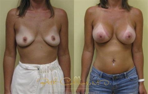 Breast Augmentation For Guilford Mystic New Haven New London Ct