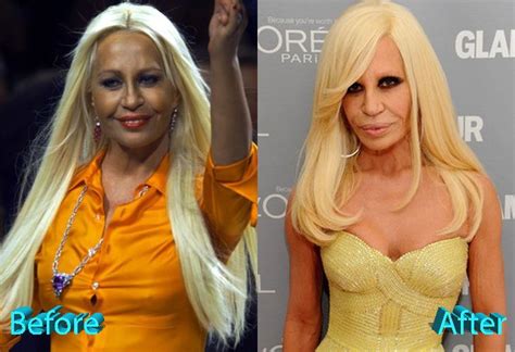 Donatella Versace Before And After Multiple Surgeries Donatella