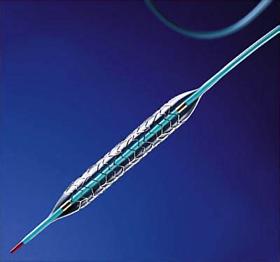 Drug Eluting Stents Show Promise Allergy And Clinical Immunology