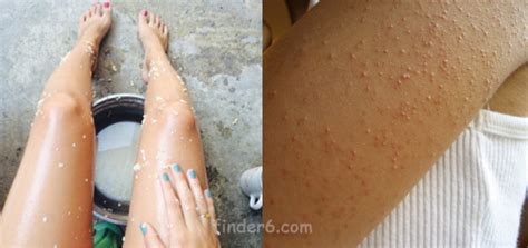 Facts You Should Know About Keratosis Pilaris The Bumpy Red Skin On Your Arms Entertainment