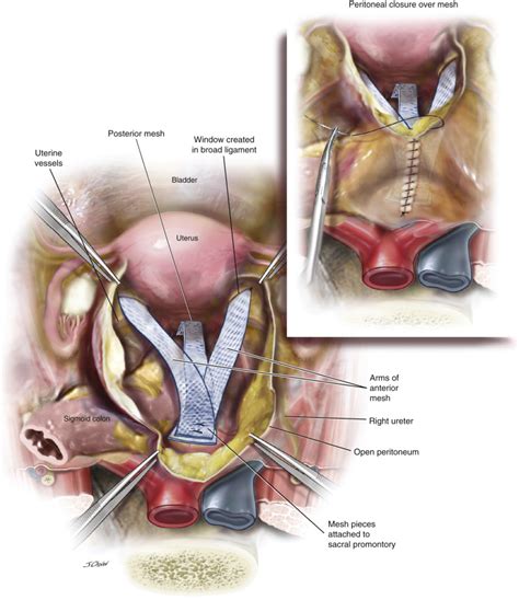 Uterine Conservation For The Surgical Treatment Of Uterovaginal