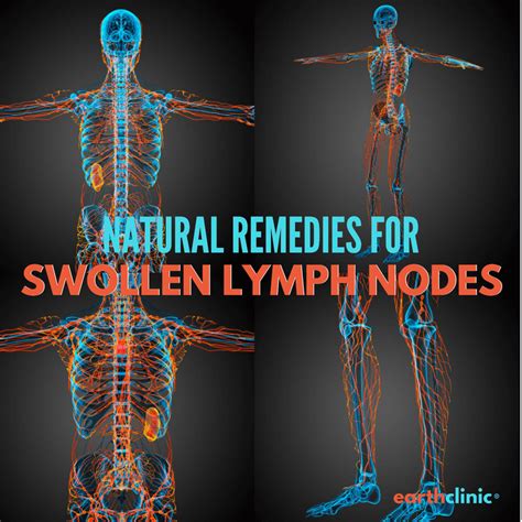 Swollen Lymph Nodes Natural Remedies