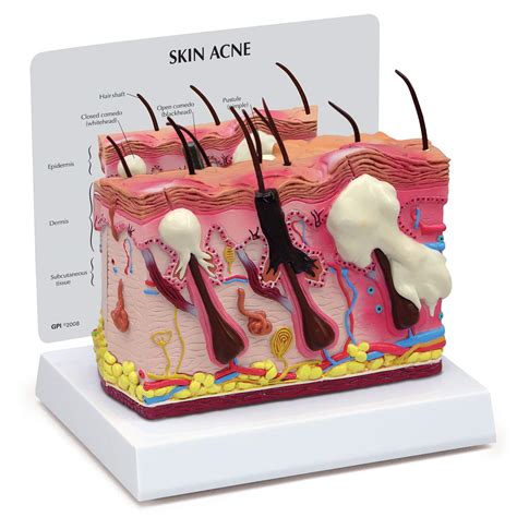 Buy Gpi Anatomicals Skin Acne Model Cross Section Showing Normal And
