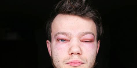 Réaction Allergique Dans Les Yeux Dun Homme œdème De Quincke