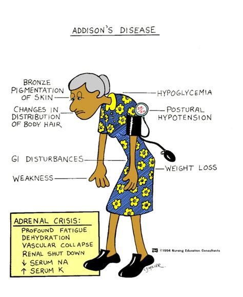 All For Nursing Ms Addisons Disease Vs Cushings Disease