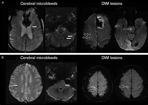 Cerebral Microbleeds In Patients With Acute Subarachnoid Hemorrhage