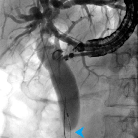 Cholangiogram Showing A Dilated Biliary Tree With Distal Bile Duct