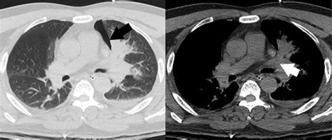 A pneumothorax can be a complete lung collapse or a collapse of only a portion of the lung. Pneumothorax on chest CT. Chest CT scan showed ...