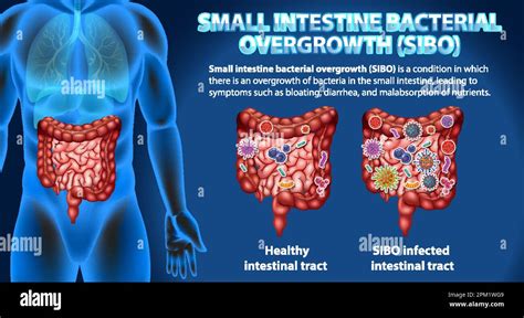 Small Intestine Bacterial Overgrowth Sibo Illustration Stock Vector