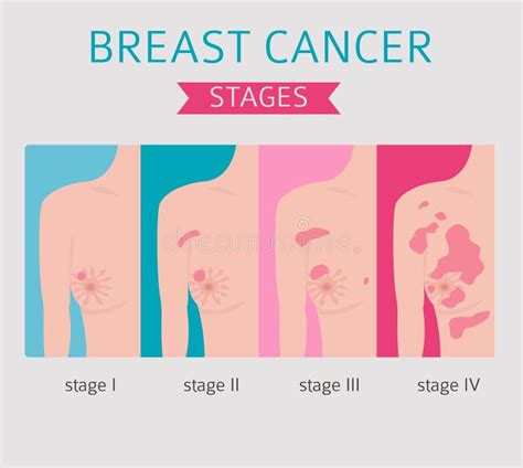 Breast Cancer Medical Infographic Diagnostics Symptoms Treat Stock Vector Illustration Of