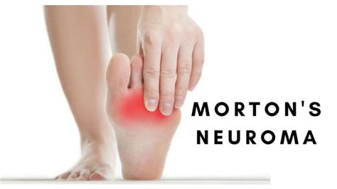 What Is Mortons Neuroma Mortons Neuroma Foot Symptoms Images And
